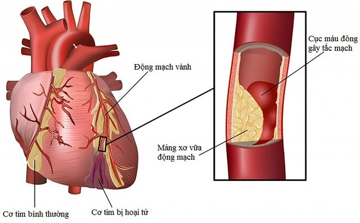 nguy cơ mắc bệnh tim mạch